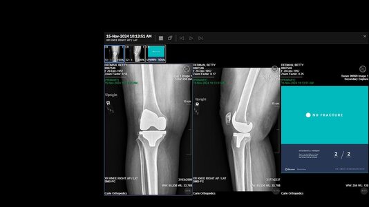 Right Knee xrays post surgery,  11-15-24, minus private information.jpg